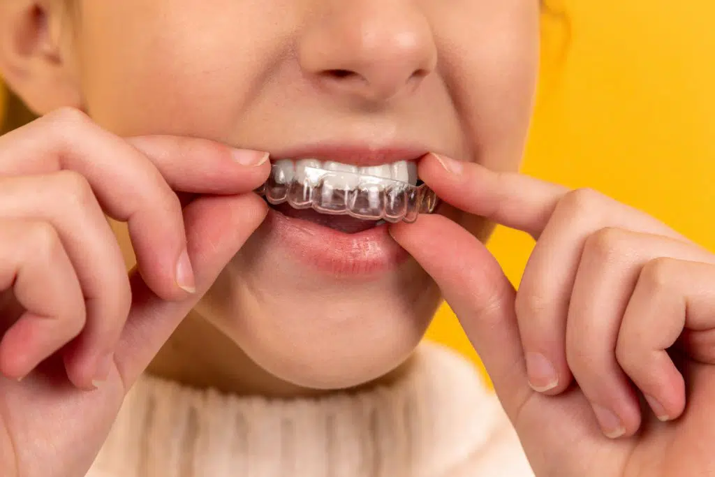 Invisalign-adolescentes