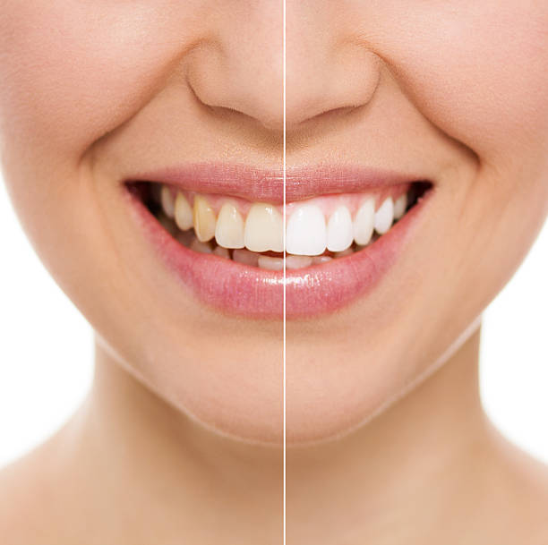 blanqueamiento dental