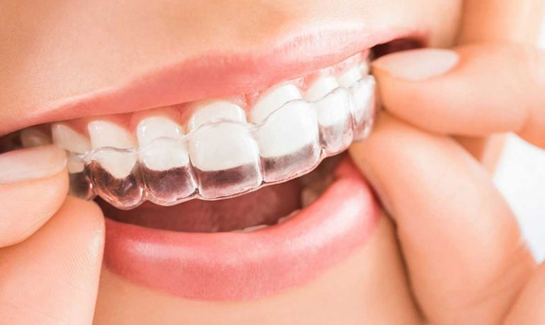 invisalign