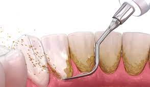 limpiezas dentales alcobendas