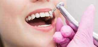 limpiezas dentales